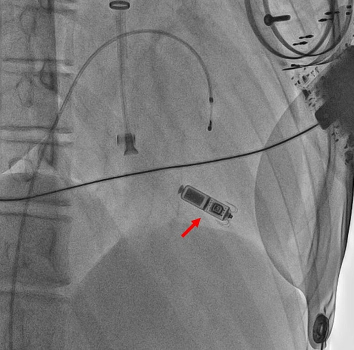 Beijing Tiantan Hospital: China's First Leadless Pacemaker Implantation for Adult Mitochondrial Encephalomyopathy