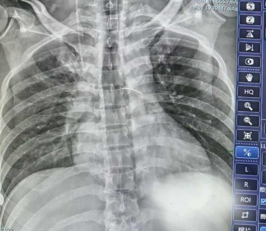 CPB-Supported Emergency Surgery for Complex Penetrating Cardiac Injury | The Second Hospital of Jilin University