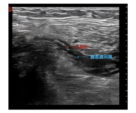 Pre-emptive Analgesia for Hip Fractures: How Beijing Tongren Hospital Reconstructs Safety Barriers for Ultra-Elderly Patients