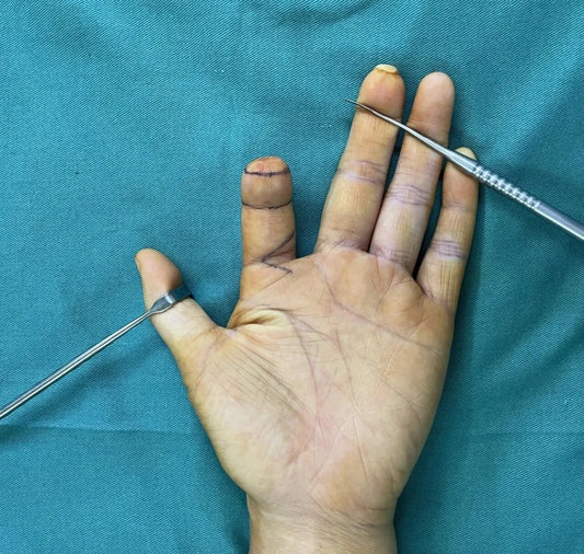 Exploring an 8-Hour Microsurgical Challenge at Beijing Jishuitan Hospital: Clinical Decision-Making and Technical Realization of Aesthetic Right Index Finger Reconstruction