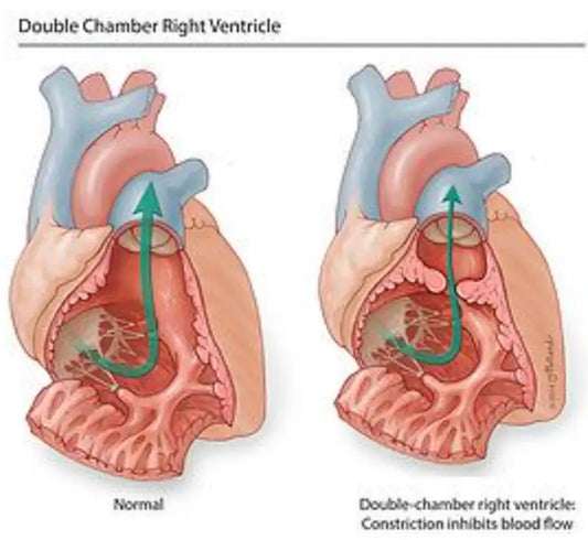 Diagnosis and Treatment of Rare Cardiac Condition in Malaysian Patient at Beijing Hospital