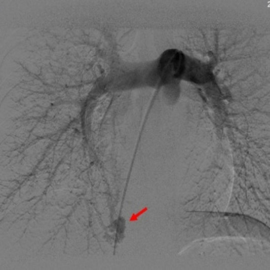 One-Stop Closure of PAVF and PFO at Beijing Tiantan Hospital