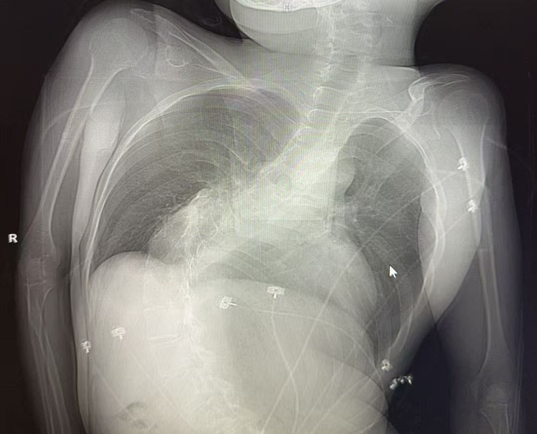 Right-Sided Left Bundle Branch Area Pacing in a Patient With Severe Scoliosis