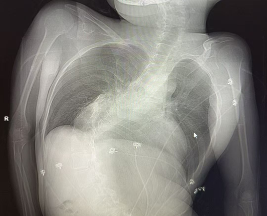 Right-Sided Left Bundle Branch Area Pacing in a Patient With Severe Scoliosis