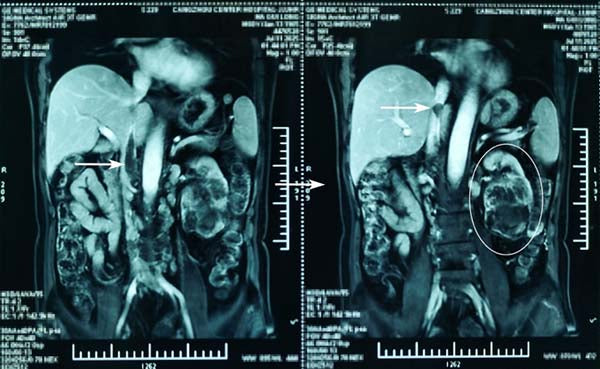 [Case Review] Bypassing DHCA &amp; Sternotomy: A Normothermic, Beating-Heart Approach to Mayo III IVC Thrombus
