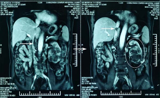 [Case Review] Bypassing DHCA &amp; Sternotomy: A Normothermic, Beating-Heart Approach to Mayo III IVC Thrombus