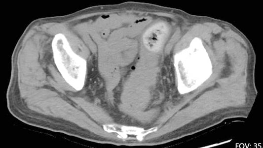 Beijing Chaoyang Hospital General Surgery Center: Successful Laparoscopic Radical Resection for a 93-Year-Old