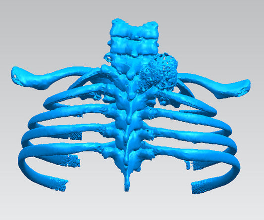 🏥 Recently at Peking University First Hospital, our team managed an anatomically demanding case of a T1 vertebral chondrosarcoma.