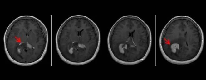 Sanbo Brain Hospital Case Review: Breaking the Ceiling for Multi-Drug Resistant Recurrent PCNSL