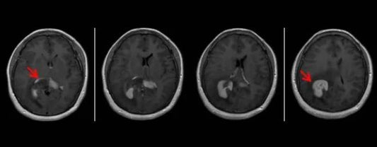 Sanbo Brain Hospital Case Review: Breaking the Ceiling for Multi-Drug Resistant Recurrent PCNSL