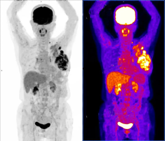 Technical White Paper: Universal Medical Standards for Precision PET/CT Staging and Multidimensional Diagnosis of Invasive Breast Cancer with Cutaneous Infiltration