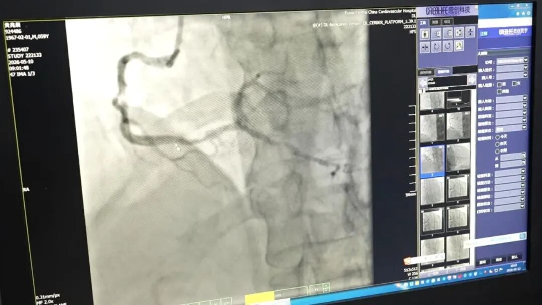 Multidisciplinary Team at Fuwai Hospital, Beijing Successfully Performs Ultra-High-Risk Retrograde PCI for Left Main CTO