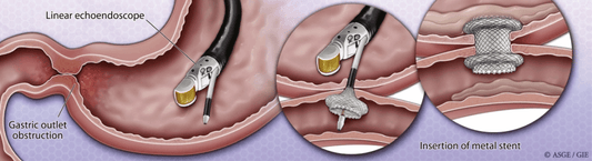 Multidisciplinary Excellence: Peking University Third Hospital Successfully Performs EUS-Guided Gastroenterostomy