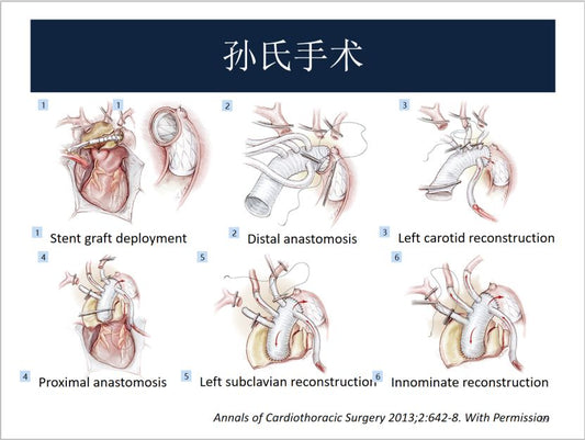 The "Gold Standard" in Cardiac Surgery: Conquering Porcelain Aorta at Fuwai Hospital Beijing