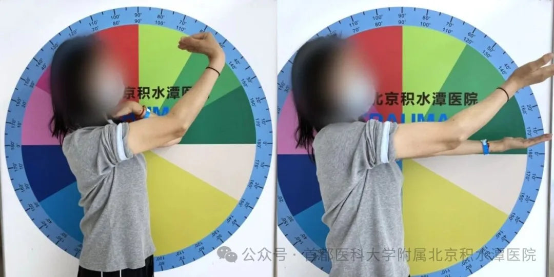 Beijing Jishuitan Hospital: Application of Internal Joint Stabilizer (IJS) in Chronic Elbow Instability