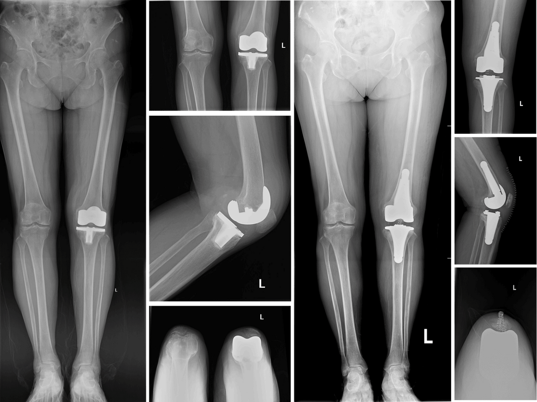 PUTH Orthopedics: Robotic-Assisted 3D-Printed Cementless Revision TKA