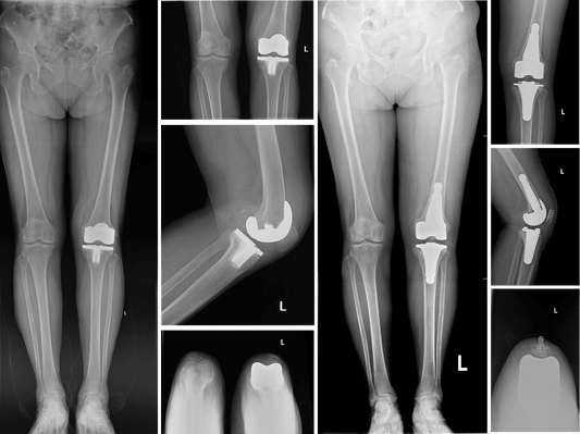 PUTH Orthopedics: Robotic-Assisted 3D-Printed Cementless Revision TKA