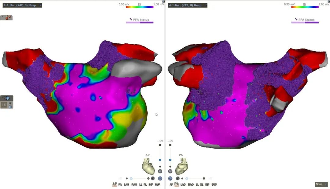 Fuwai Central China Hospital Successfully Performs 3D-PFA + LAAC Combined Procedure for Severe Spinal Deformity