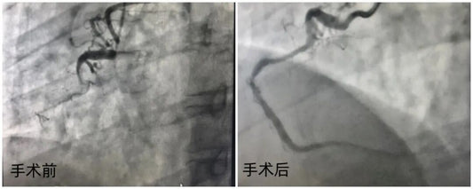 Technical Standards: Clinical Decision Pathways for "Intervention Without Implantation" in Complex Angulated CTOs
