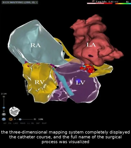 Breakthrough in VT Ablation: Overcoming Double Mechanical Valves at Tianjin Chest Hospital