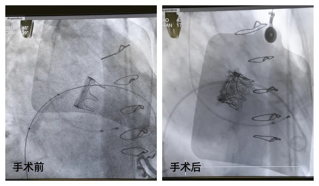 TMVIV Minimally Invasive Valve Repair: Fu Wai Hospital Successfully Treats 83-Year-Old High-Risk Patient