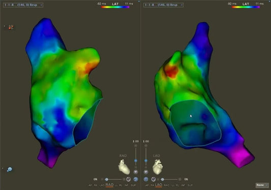 Beijing Fuwai Hospital: Cryoballoon Ablation as a Salvage Strategy for RAA Tachycardia