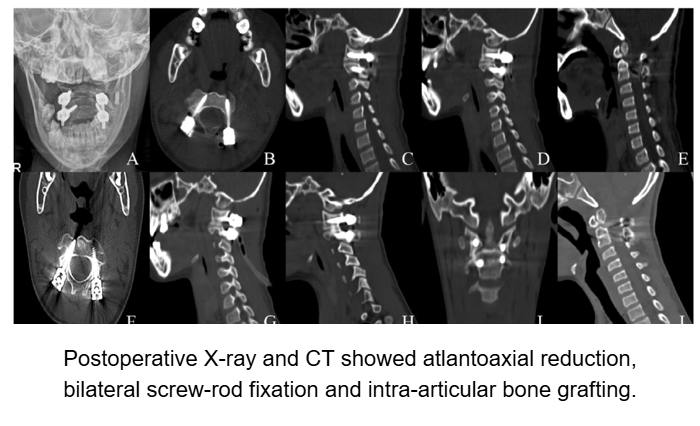 Endoscopic-Assisted Atlantoaxial Fusion: A Minimally Invasive Approach to Upper Cervical Instability