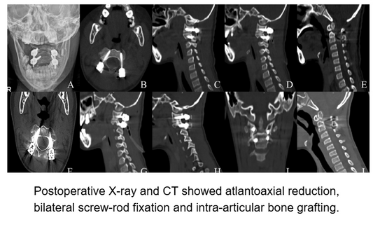Endoscopic-Assisted Atlantoaxial Fusion: A Minimally Invasive Approach to Upper Cervical Instability