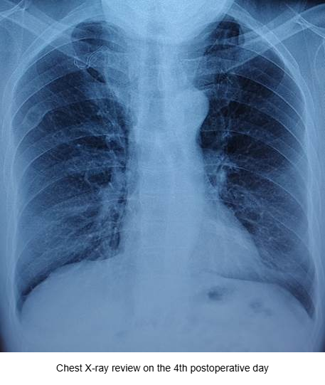 Tracheal Papilloma at Peking University Third Hospital: Abandoning Intubation Intraoperatively for Laryngeal Mask Anesthesia with Superficial Cervical Plexus Block