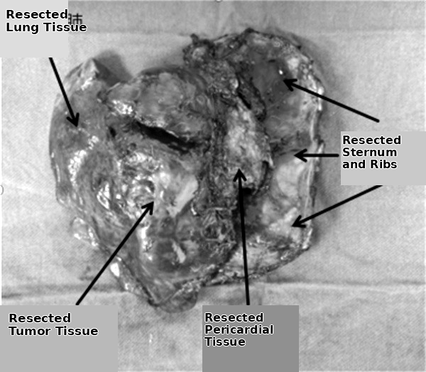 Peking University First Hospital: Neoadjuvant Downstaging and Resection of a Massive Chest Wall Sarcoma