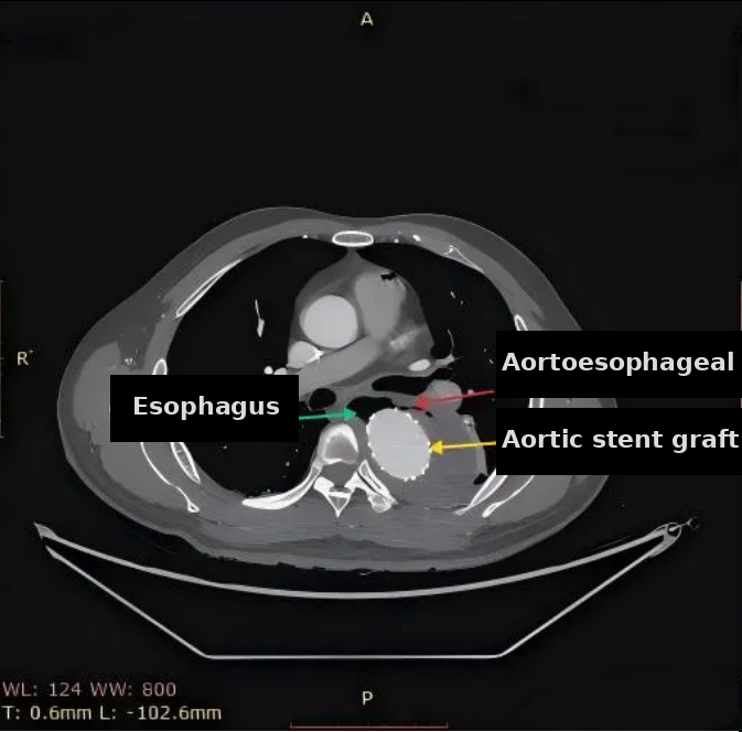 [Case Report] Peking Union Medical College Hospital: A Two-Stage Surgical Strategy for Post-TEVAR Aortoesophageal Fistula (AEF)