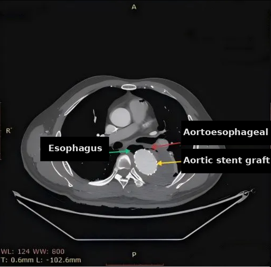 [Case Report] Peking Union Medical College Hospital: A Two-Stage Surgical Strategy for Post-TEVAR Aortoesophageal Fistula (AEF)