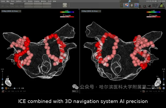 Clinical Technology | Harbin Medical University Overcomes Anatomical Barriers in "One-Stop" Procedure Post-ASD Closure Using ICE