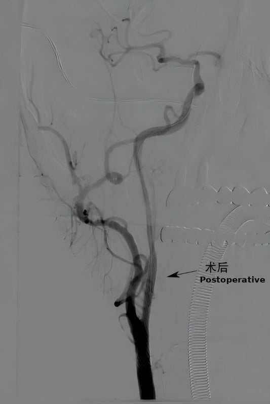 MDT at Renmin Hospital of Wuhan University Successfully Performs TCAR for High-Risk Severe Carotid Stenosis