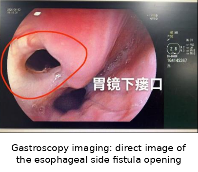 Tubeless Surgery for Adult Congenital Tracheoesophageal Fistula at Fujian Medical University Union Hospital
