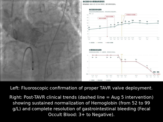Renmin Hospital of Wuhan University: Transfemoral TAVR for Complex Heyde Syndrome