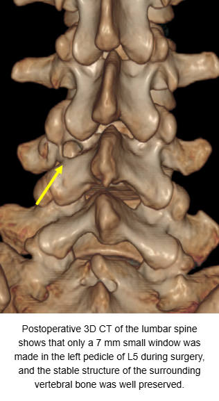 Robot-Guided Full-Endoscopic Resection of an L5 Osteoid Osteoma: Precise Targeting and Preservation of Spinal Structures