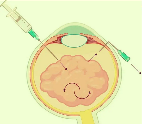 PUMCH: Minimalist Bent-Needle Technique Resolves Recurrent Post-Vitrectomy Hemorrhage