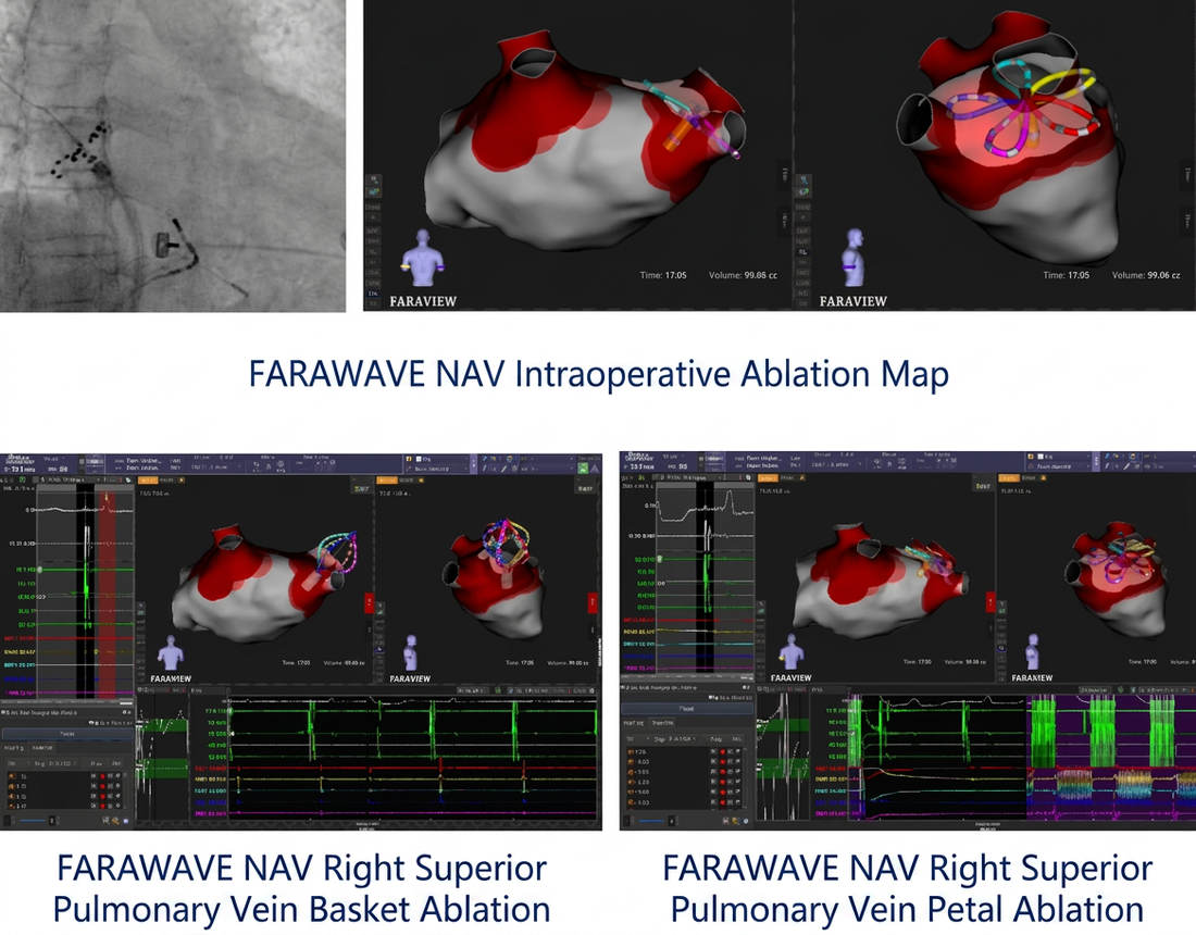 Fuwai Hospital: 3D Pulsed Field Ablation (PFA) Breaks Through Bottlenecks in High-Risk Persistent AFib Treatment