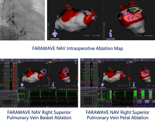 Fuwai Hospital: 3D Pulsed Field Ablation (PFA) Breaks Through Bottlenecks in High-Risk Persistent AFib Treatment