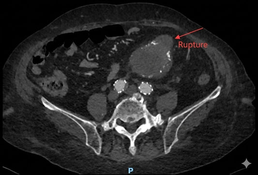 The 120mm Aneurysm Challenge: How Beijing Fuwai Hospital Expert Team Defused a Secondary Rupture Crisis in an 85-Year-Old Patient.